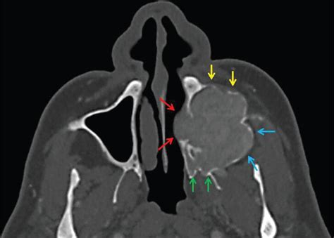 Computed Tomography Findings Of An Unusual Maxillary Sinus Mass Brown