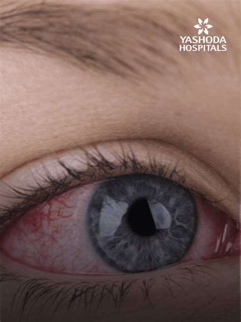 Pink Eye Conjunctivitis Your Guide To Eye Health And Care