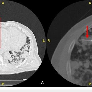 Axial Computed Tomography Ct In Lung Window Demonstrating Multiple