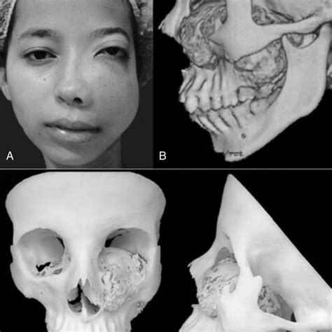 A The Frontal View Of The Patient In The Preoperative B Computed Download Scientific