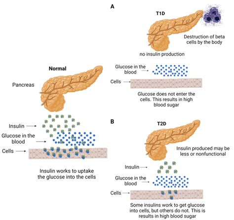 Demonstration Of T1D A And T2D Pathophysiology Compared To Normal