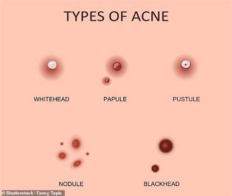 White Head Bumps