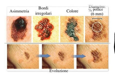 Melanoma In Italia Casi L Anno Per Questo Aggressivo Tumore