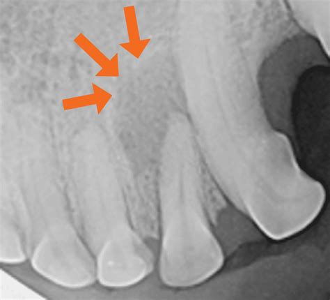 Cracked Tooth Xray