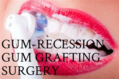 gum-recession-gum-grafting-surgery