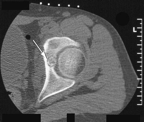 Technical Considerations In Ct Guided Radiofrequency Thermal Ablation