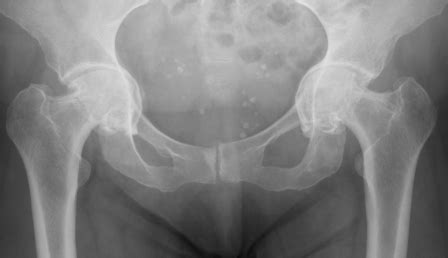 Triradiate Pelvis Osteomalacia