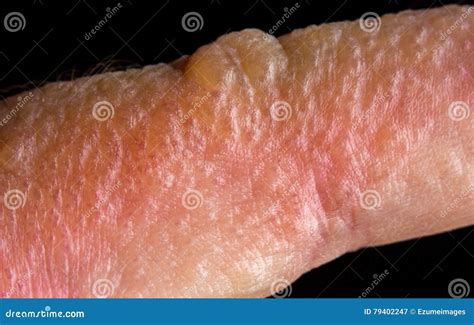 Poison Ivy Rash stock image. Image of bumpy, allergy - 79402247