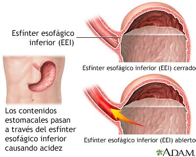 Enfermedad Por Reflujo Gastroesof Gico Medlineplus Enciclopedia M Dica