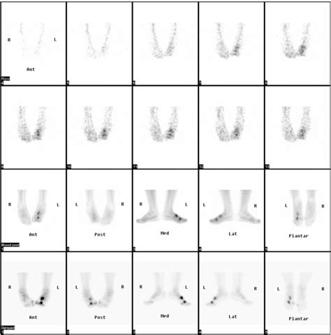 Figure 1 From Optimal Imaging Positions For 3 Phase Bone Scanning Of