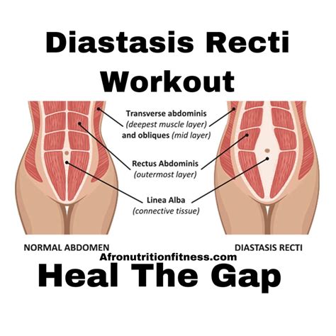 Diastasis Recti Exercises