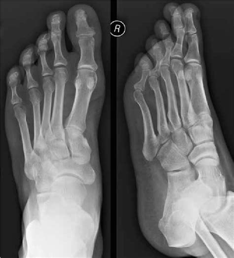 Figure 4 from Diagnostic imaging of psoriatic arthritis. Part I: etiopathogenesis ...