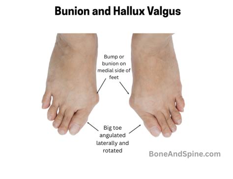 Hallux Valgus Angle Normal Range