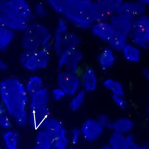 Figure 2 From Crizotinib For Ros1 Rearranged Non Small Cell Lung