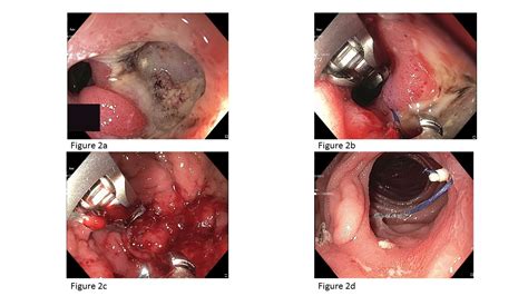 Ssat Endoscopic Management Of Recalcitrant Marginal Ulcers By