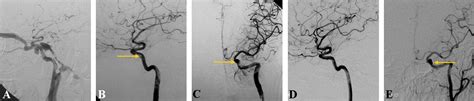 Endovascular Treatment Of Post Traumatic Direct Carotid Cavernous Fistulas A Single Center