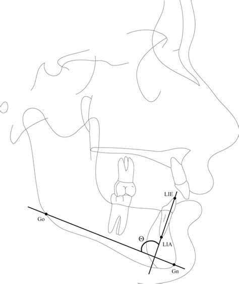 Loinc Incisor Mandibular Plane Angle Using Gnathion Skull X Ray