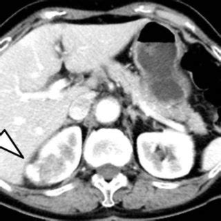 Enhanced Abdominal Computed Tomography Ct Abdominal Ct Revealed A