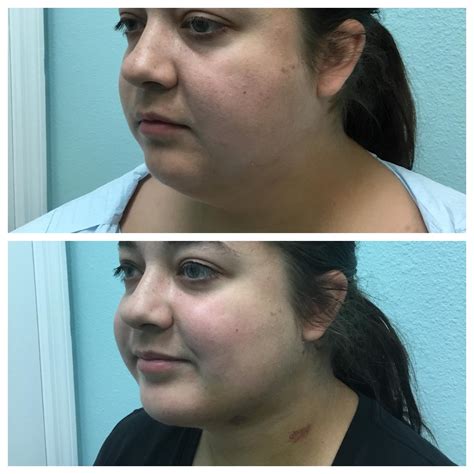 Chin & Neck Lipo - Tampa, FL: Tampa Bay Body Sculpting