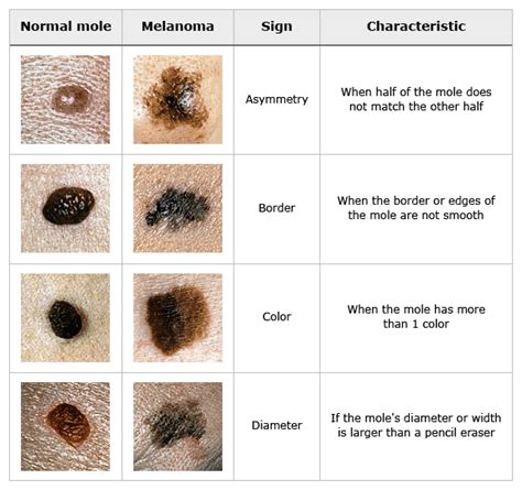 Pie Melanoma