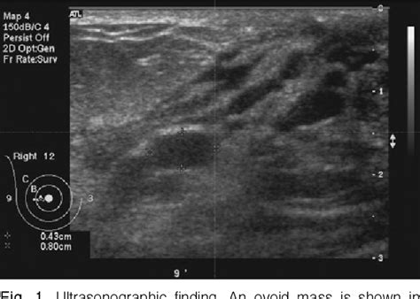 Figure 2 From Fine Needle Aspiration Cytology Of Periductal Mastitis Subareolar Abscess And