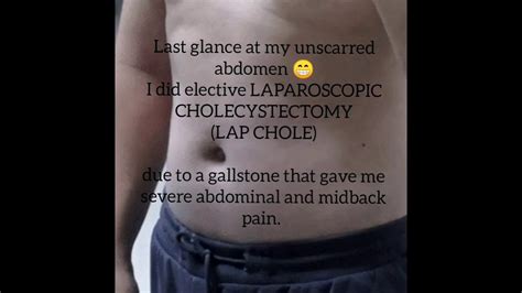 Laparoscopic Cholecystectomy Lap Chole Scars Youtube