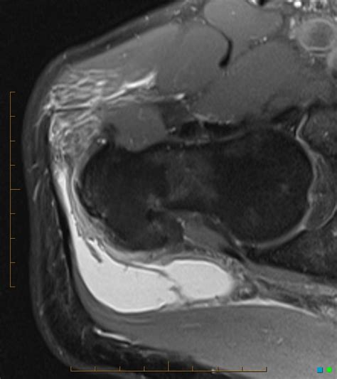 Ruptured Sub Gluteus Maximus Trochanteric Bursa Image