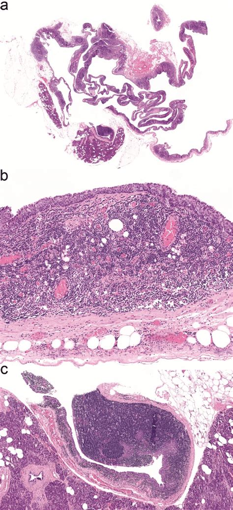 A Low Power View Of Cyst Lined By Squamous Epithelium With Lymphoid