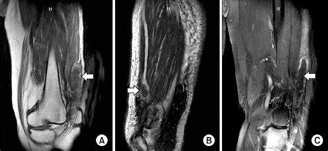 Postoperative MR images show the remnant malignant fibrous histiocytoma ...