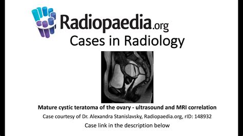 Mature Cystic Teratoma Of The Ovary Radiopaedia Org Cases In