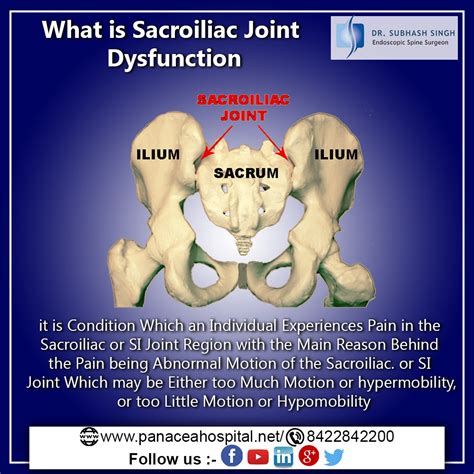 What Is Sacroiliac Joint Dysfunction