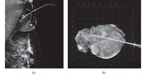 Figure 3 From A Nonpalpable Nodule In Ectopic Axillary Breast Tissue