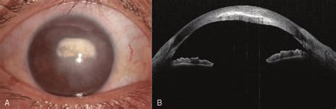 A Slit Lamp Photo Indicated A Stromal Corneal Scar Of The Right Eye