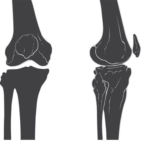 Knee Joint Png Knee Joint Png Is A Free Transparent Background Images ...