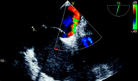 Foramen Oval Permeable Cardiavant