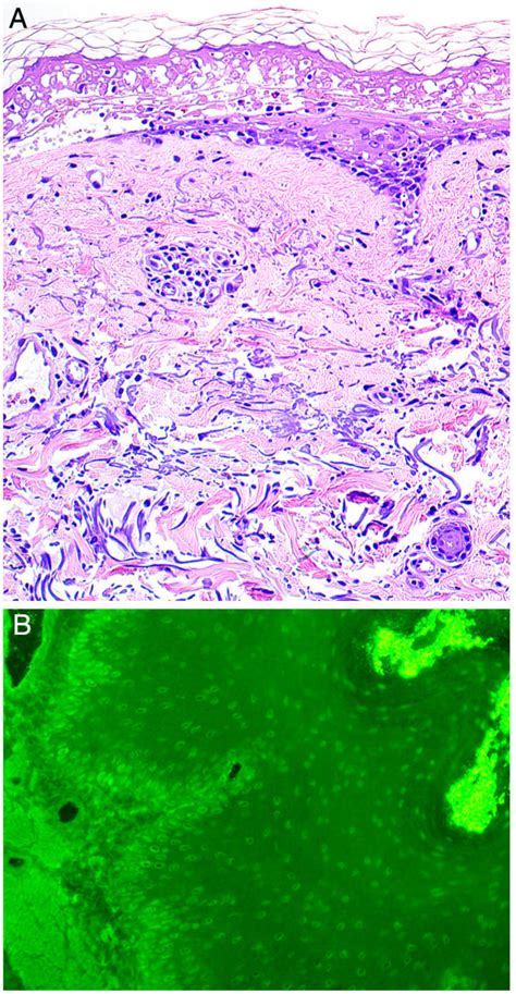 Indirect Immunofluorescence Findings In A Patient With Toxic Epidermal