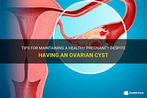 Tips For Maintaining A Healthy Pregnancy Despite Having An Ovarian Cyst