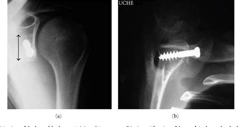 Figure 5 From Mini Open Latarjet Procedure For Recurrent Anterior