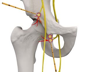 Radiofrequency Neurotomy Brisbane Hip Clinic Australia