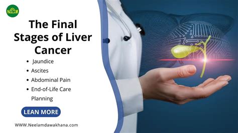 Understanding The Final Stages of Liver Cancer: Symptoms, Treatments ...