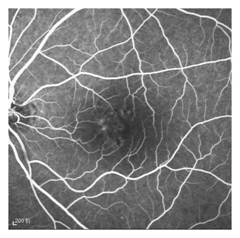 A 50 Year Old Male Patient Who Underwent Half Dose PDT Ac FFA