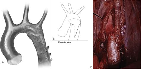 Aortic Coarctation Repair How I Teach It The Annals Of Thoracic Surgery