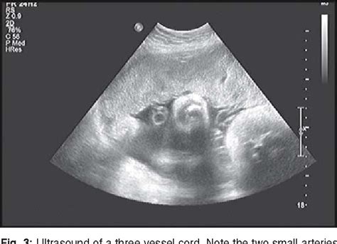 Ultrasound of the Placenta | Semantic Scholar