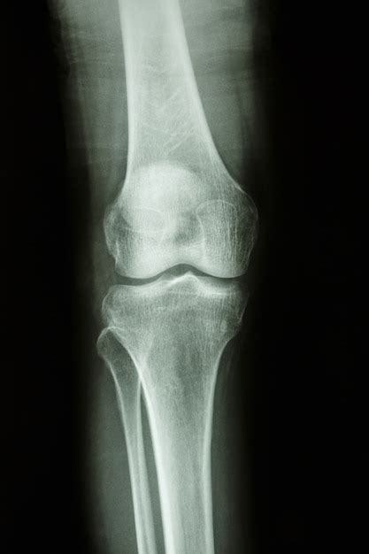 Radiografía De La Rodilla De La Articulación De La Rodilla Humana