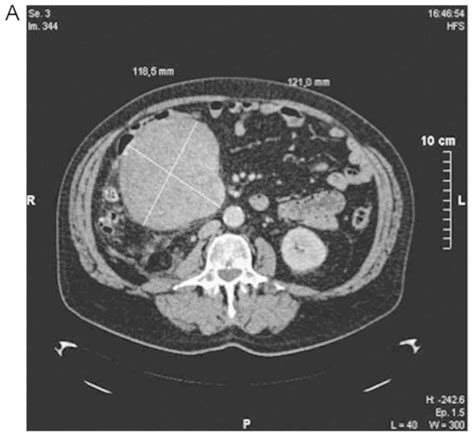 Robotic Resection Of A Giant Retroperitoneal Leiomyosarcoma A Case Report