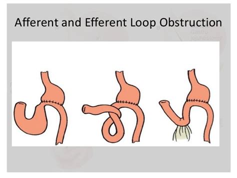 Postgastrectomysyndrome