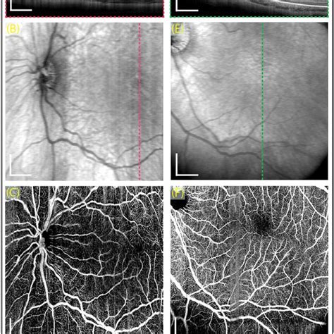 Representative Swept Source Optical Coherence Tomography Angiography