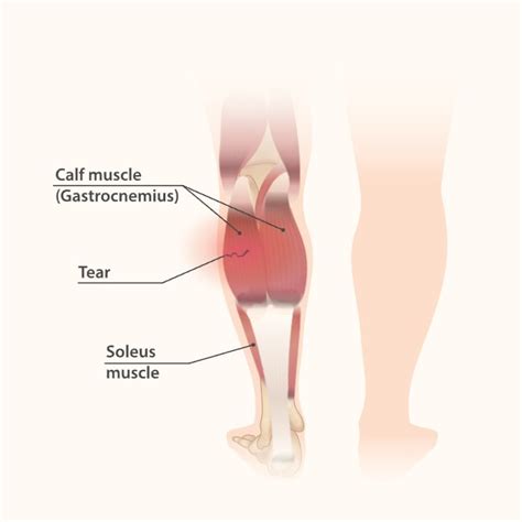 Fabulous Tips About How To Soothe Sore Calf Muscles - Fishreward32