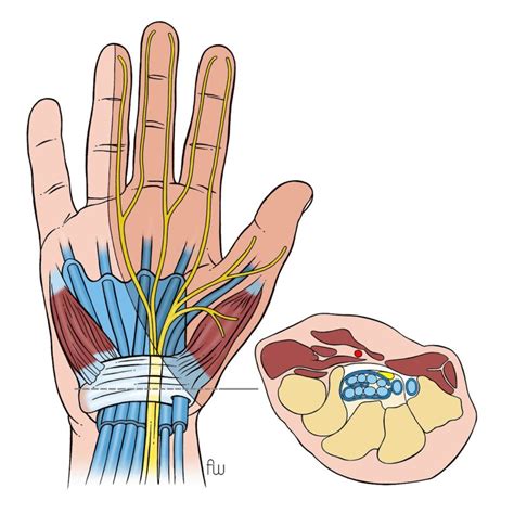Carpaal Tunnel Syndroom Cts Ikazia Ziekenhuis