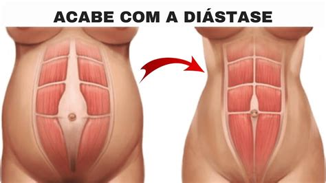 exercícios para diastase na gravidez e recuperar diástase pós gravidez